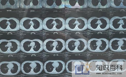 什么情况需要做肺部CT1
