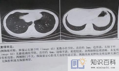 什么情况需要做肺部CT2