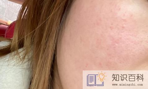激素脸排出来的激素怎么看得出来3
