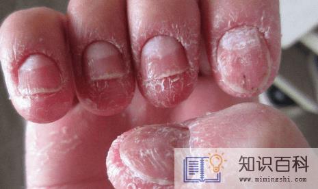 为什么年纪轻轻得了灰指甲2
