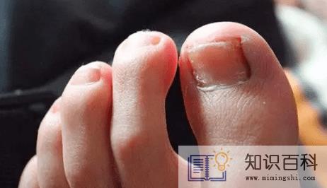 为什么年纪轻轻得了灰指甲3