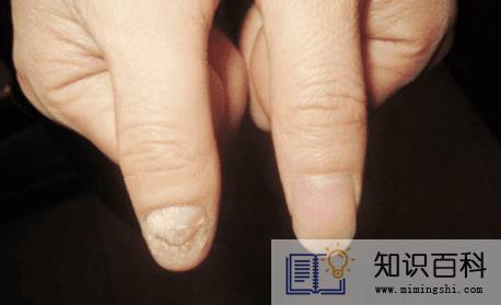 灰指甲说明身体哪里不好2