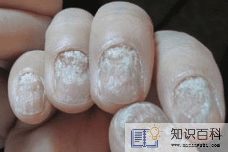 灰指甲说明身体哪里不好3