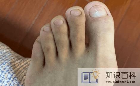 10个灰指甲大概多少钱1