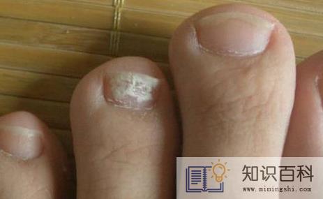 10个灰指甲大概多少钱2