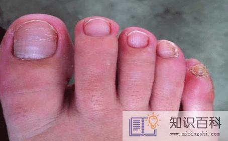 10个灰指甲大概多少钱3