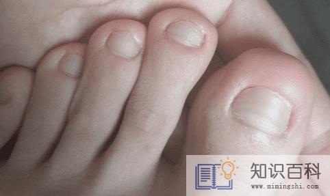 女朋友很漂亮但是有灰指甲怎么办3
