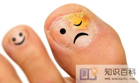 灰指甲是一碰就传染吗1