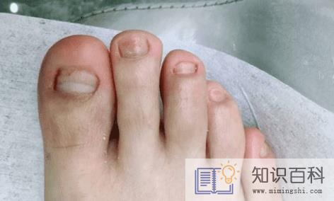 女生得了灰指甲是不是很尴尬1