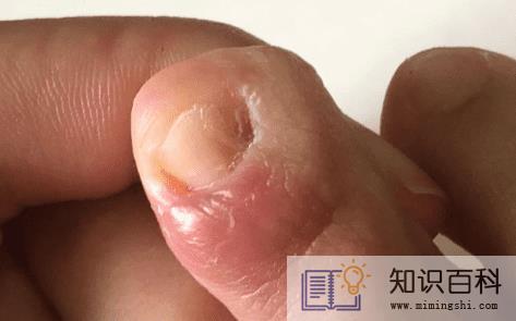 女生得了灰指甲是不是很尴尬2