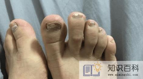 女生得了灰指甲是不是很尴尬3