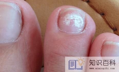 灰指甲要刮多薄指甲才能涂药1