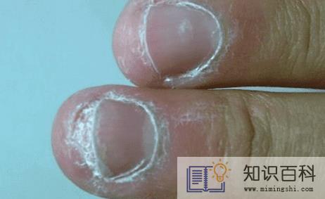 灰指甲要刮多薄指甲才能涂药2