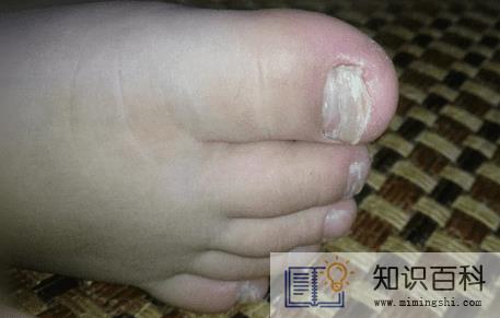 灰指甲根本就治不好吗2