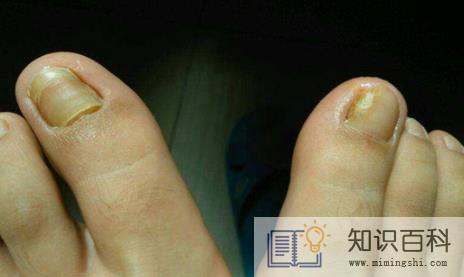 灰指甲竟然自己好了怎么回事1