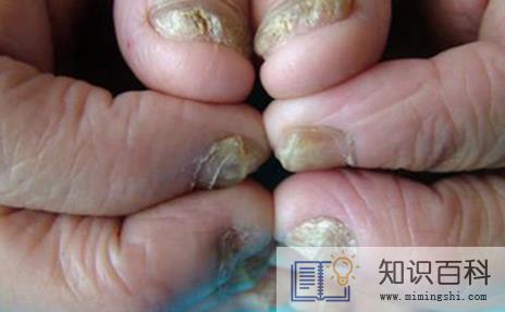 灰指甲竟然自己好了怎么回事2