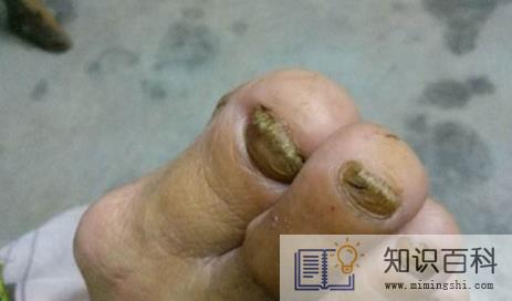 灰指甲竟然自己好了怎么回事3