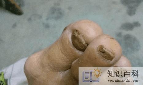 灰指甲最开始的症状会发脓吗1