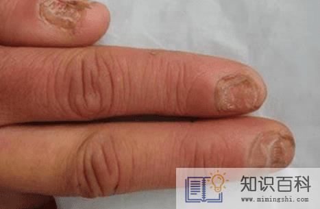 灰指甲最开始的症状会发脓吗2