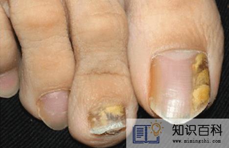灰指甲最开始的症状会发脓吗3