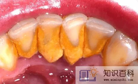 牙结石是什么样的图片1