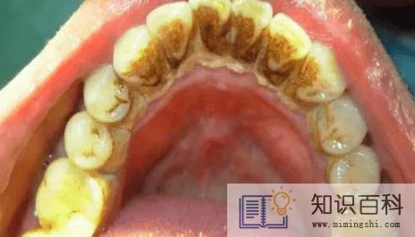 牙结石是什么样的图片3