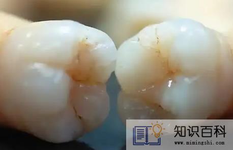 牙结石掉了牙龈空了牙龈会长吗3